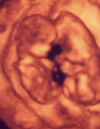 写真：妊娠12週 双子の赤ちゃん